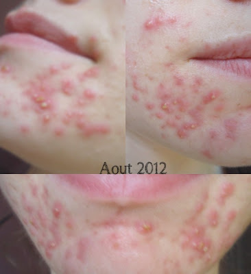L'acné: mon parcours – 3 ans de bataille ! – beauty by morgane
